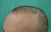 Approximately one year after transplant ‒ hair growth is much denser