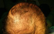 Thinning hair had been Domenico´s long-term problem