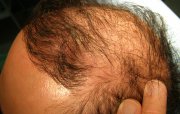 Condition of the hair before transplant