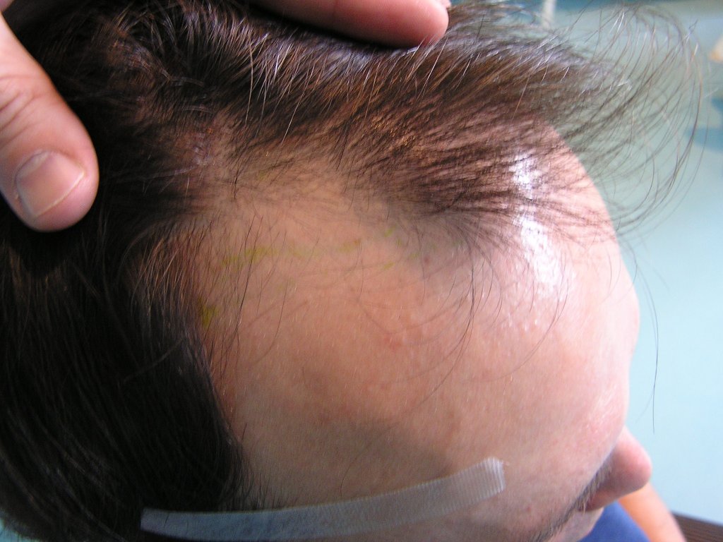 Receding hair on temples