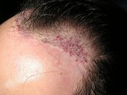 Left side of the forehead five minutes after planting hair follicular units. No bleeding, so the patient leaves the clinic.