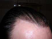 Stan po upływie 7 miesięcy. Widok prawego zakola. Wzrost włosów, ich kąt i nachylenie są naturalne, włosy nie wytwarzają żadnych kępek czy wklęsłości.