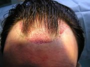 Front view. Some signs of alopecia have been preserved. The aim was not to reconstruct the front line completely. The patient didn´t want it, nor it wouldn´t  give an aesthetically good impression. 