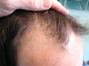 The extent of alopecia on the right side is smaller than on the left side.