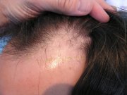 Side view – left side (classic,rapidly receding hairline). It is very important to implant the grafts also into the existing hair