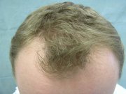 Condition of the hair before transplant