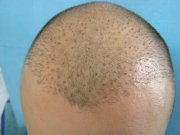 Unnaturally looking hairline resulting from the Strip method transplant in another facility