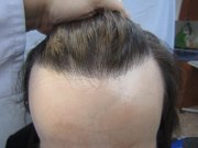 Pohled na vlasovou linii zepředu, 18 měsíců po transplantaci