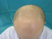 Before transplant: Ondřej had almost no hair in the middle and front of the head  