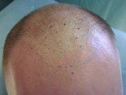 Das Bild vor der Haartransplantation, die Vorneansicht. Diese quälte ihn für 10 Jahre. Er wollte aber keine Borsten haben, die er bei seinem Freund als Resultat der älteren Methode gesehen hat.