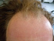 Zona con il regredire della linea frontale dei capelli dove verranno impiantati i capelli