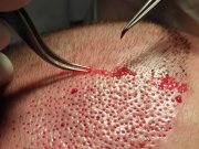 Implantation of grafts in detail