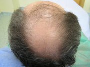 The classic example of hair loss  in the vertex 