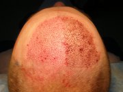 Hair transplant – day two.The right  side has already started to heal,  the grafts will be transfered to the left part of the recipient area