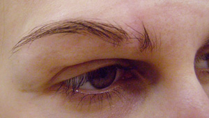 A scar caused the hairloss in eyebrows