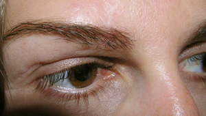 Resulting look of eyebrows after transplant