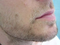 Other hair loss (beard, eyelashes)