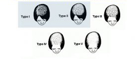 Ludwig scheme of hair loss in women